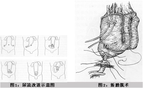 高难度膀胱全切+可控尿流改道(人造膀胱)手术成功实施