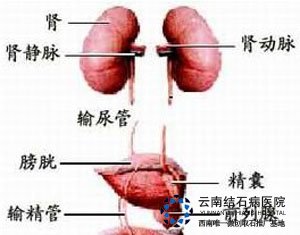 产后肾结石的症状