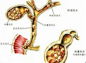 胆囊切除的后遗症有哪些