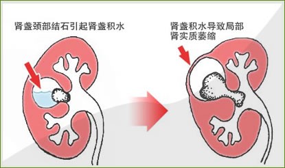 肾结石不能吃什么海鲜_肾结石吃什么药好_银霄病什么不能吃(2)