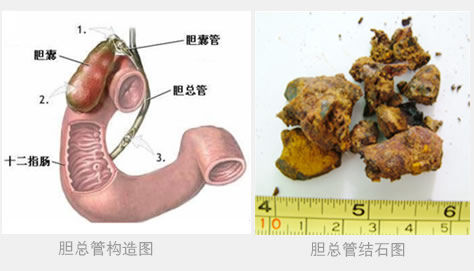 肾结石不能吃什么海鲜_肾结石吃什么药好_银霄病什么不能吃(3)